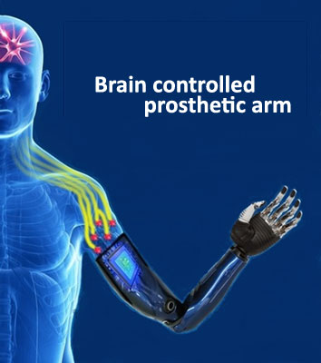 Prosthetic arm
