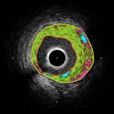 Intravascular ultrasound (IVUS)